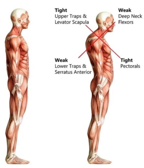 Posture and Upper Crossed Syndrome | Health-Fit