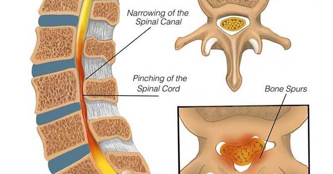 Lumbar Spinal Stenosis 