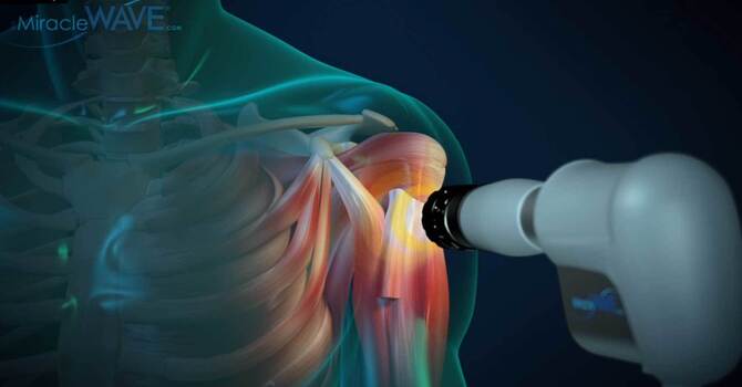 Shockwave Therapy